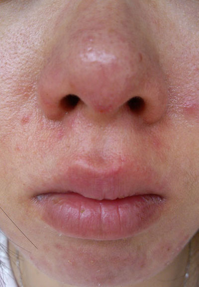 脸上有螨会有什么症状呢？教你这样除螨，让螨虫无处可在