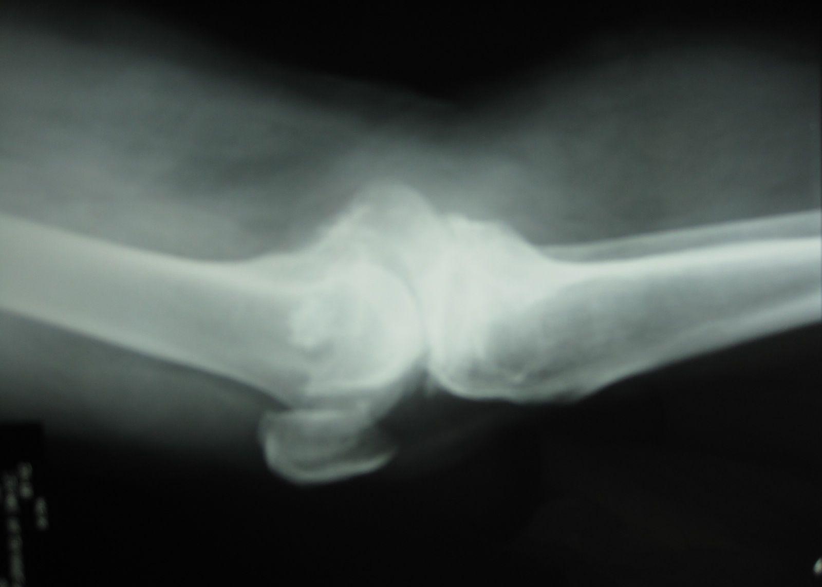 膝关节脱位，可以采取闭合复位，一般需要对关节内的血肿进行清除