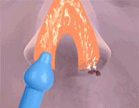 宝宝感冒鼻塞流清鼻涕一招解决,鼻塞鼻涕多通气最快方法