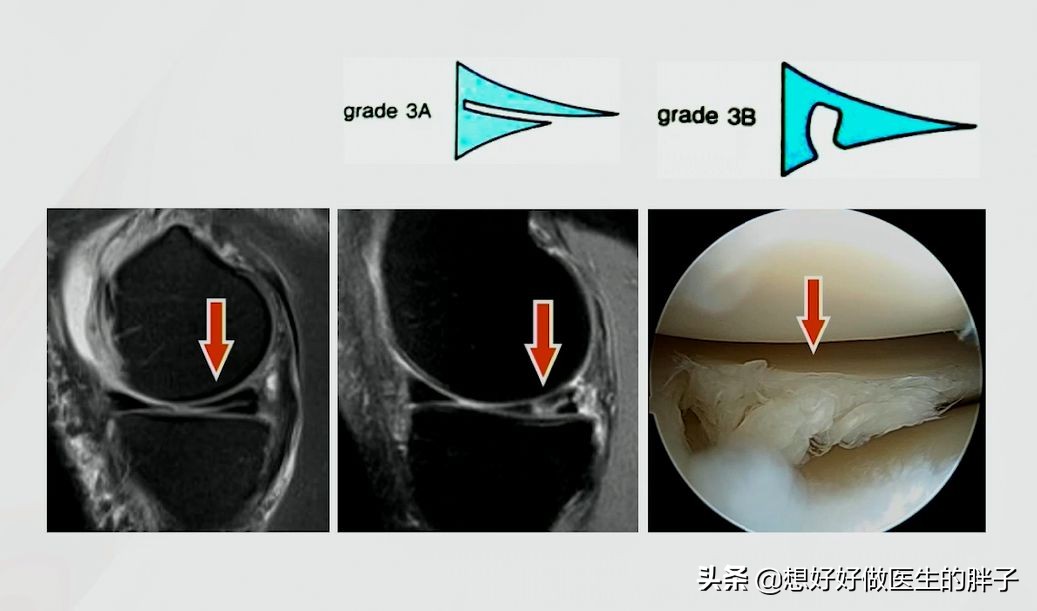 半月板损伤对足球运动员有多严重,足球运动员有半月板问题吗