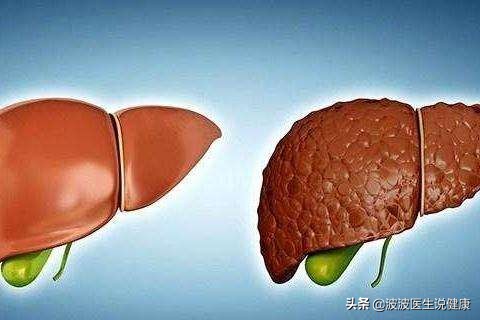 肝硬化肝癌诊治病例分享,2023年肝病防治指南