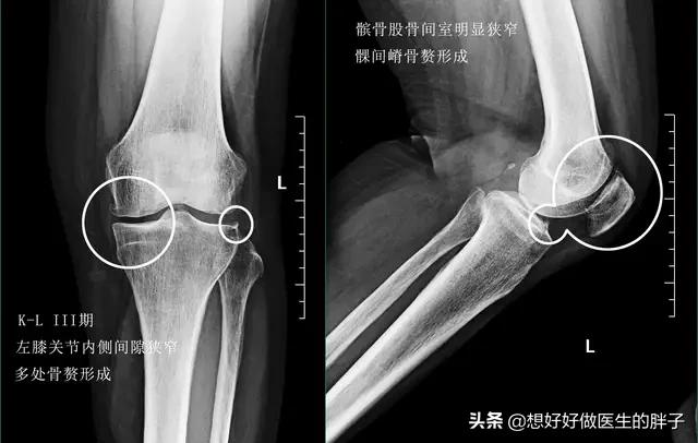 骨刺与骨性关节炎疼痛有什么区别,关节炎骨刺是怎么造成的