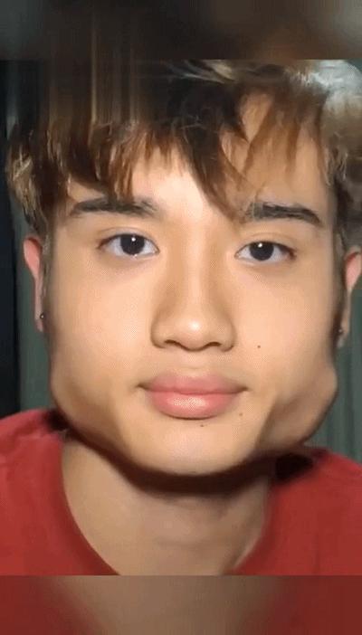 面部注射瘦脸针会有什么变化,瘦脸针肉毒素的危害和后遗症