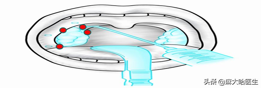 小孩扁桃体切除疼不疼,扁桃体切除术后疼不疼