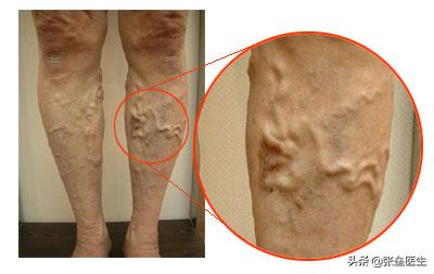 经常站立导致小腿静脉曲张,大腿上有小蚯蚓是不是静脉曲张
