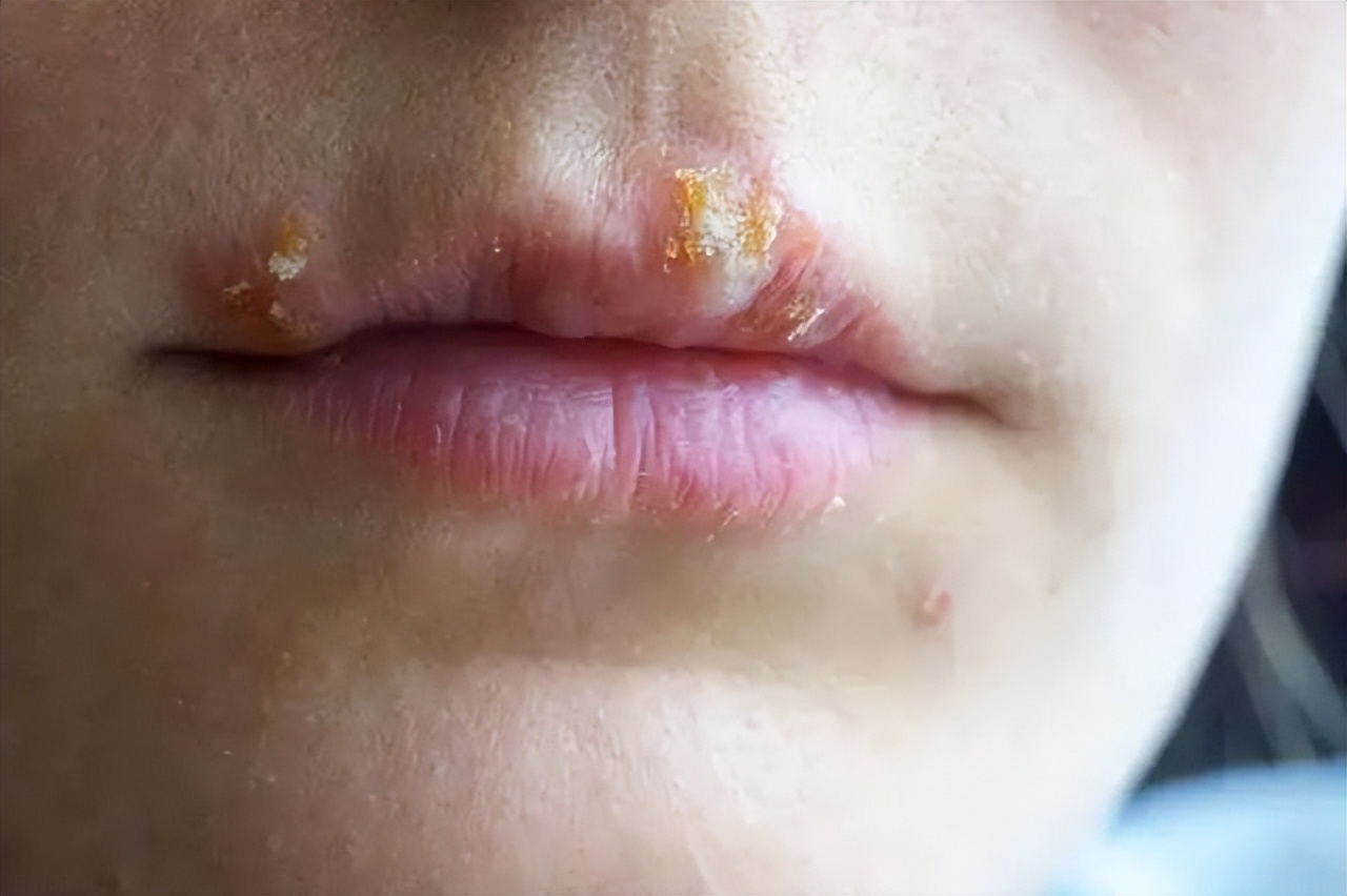 嘴巴周围有好多小水泡是上火吗,嘴上上火长水泡会传染吗