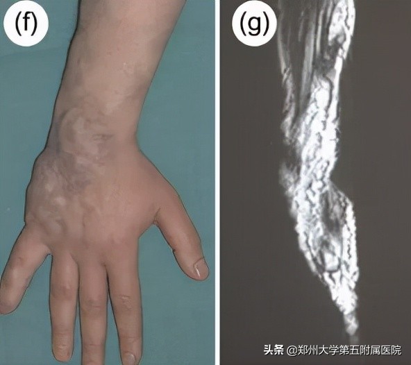 健康科普治疗结节,静脉畸形有硬肿块要做手术吗