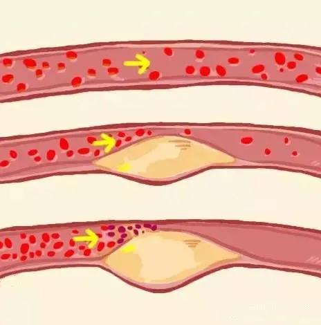 不明原因的眼皮耷拉下垂,可能是这个可怕的病