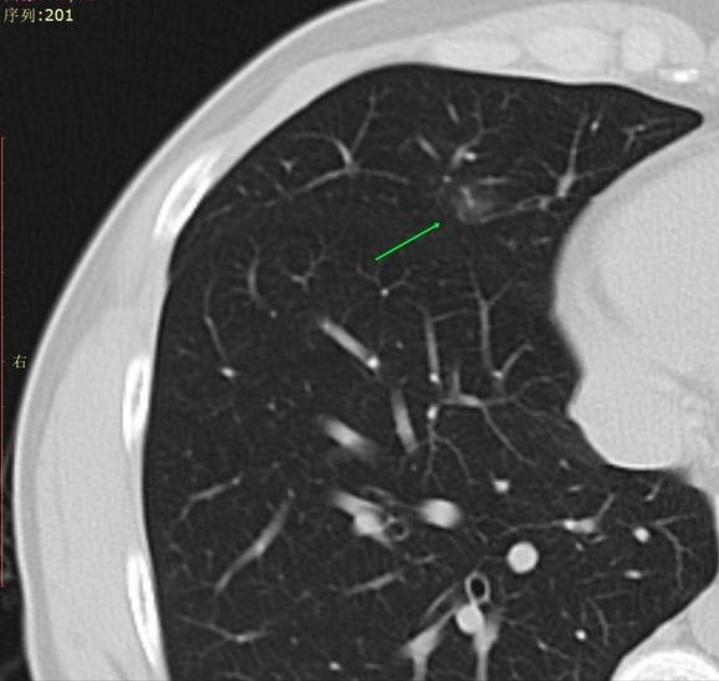 *疆新**28岁结友遇8mm混磨要手术治疗？精准诊断判定是炎症一定可消