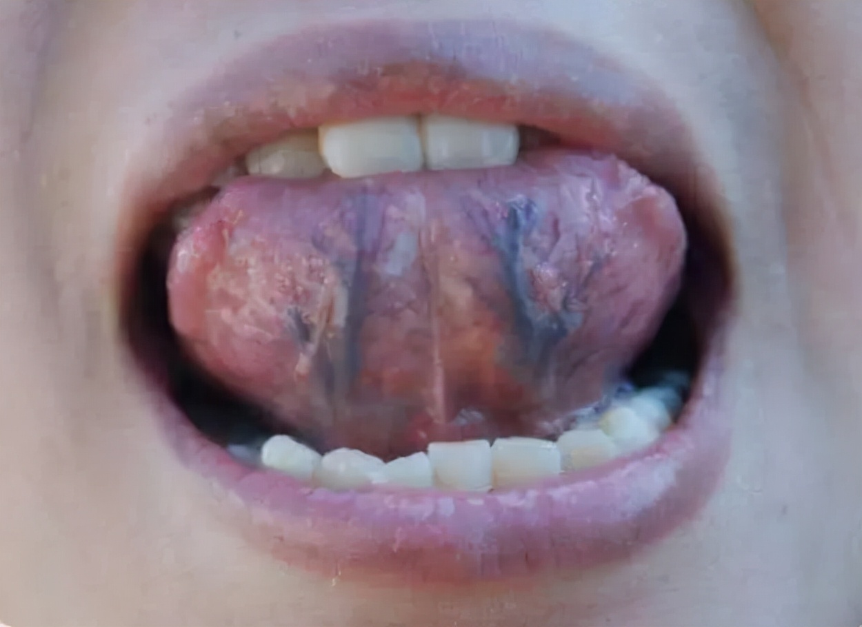 舌头颜色暗紫用什么药,舌头颜色暗紫是什么原因