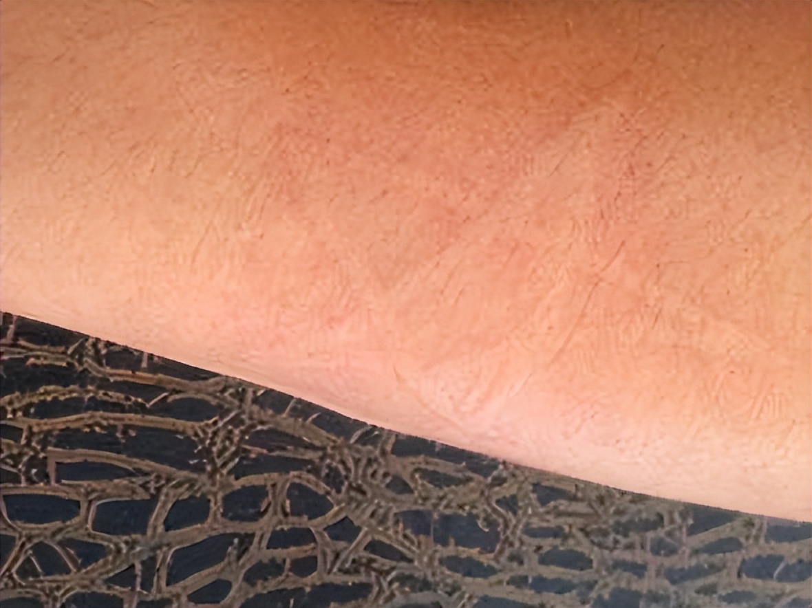 「*麻疹荨**」20%的人都会得的皮肤病，是什么原因？又该如何治疗？