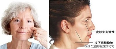 除皱针真的能让人变年轻吗,抗衰针与除皱针有啥区别