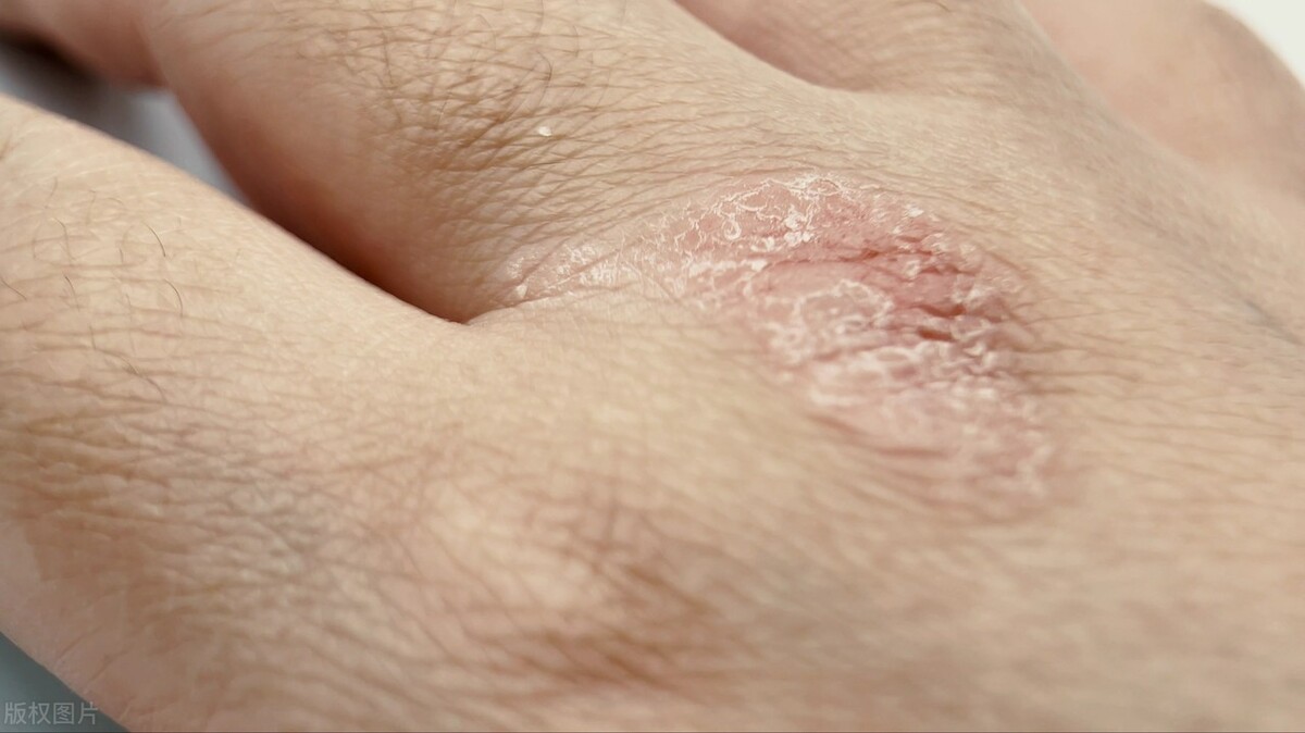 干燥综合征的病症表现，希望你没有这些情况！