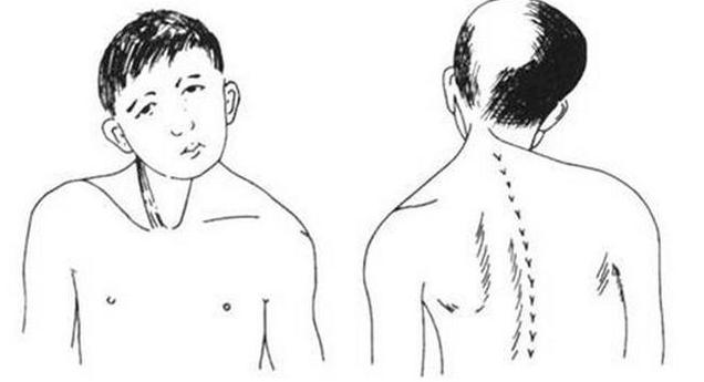 得了痉挛性斜颈该怎么办才好,其实恢复的方法很简单
