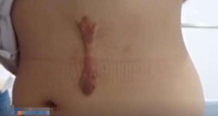 姑娘参加体检发现左肾丢失,陕西女子体检时发现左肾离奇消失