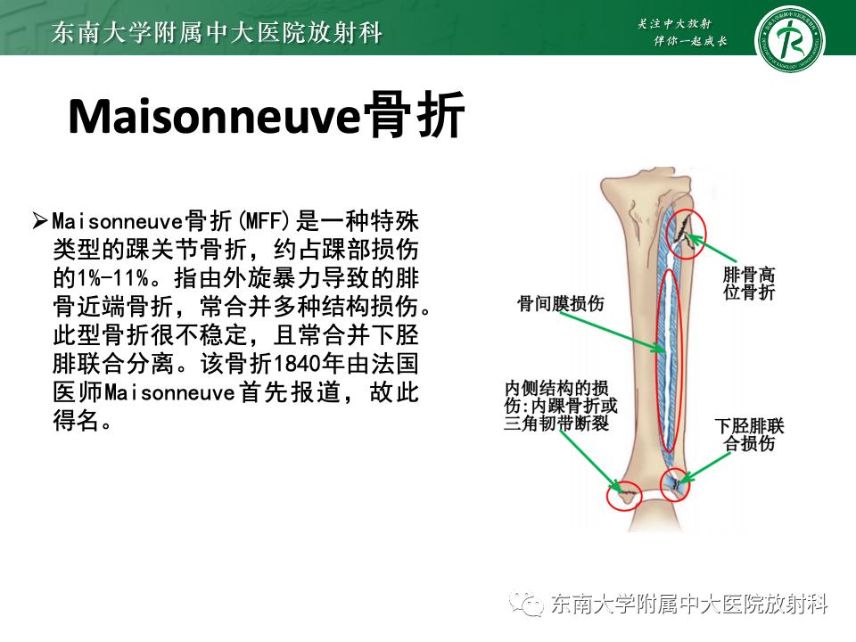 左腓骨下段骨折伴下胫腓联合分离,好文分享深度揭秘