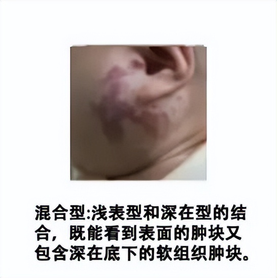 小孩胎记长肉瘤,小孩身上一块黑色胎记越长越大