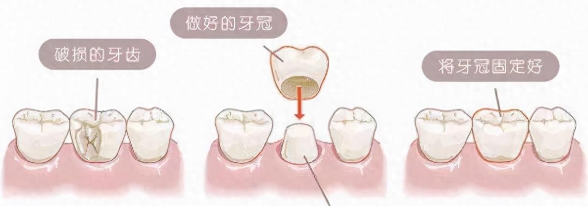 明星烤瓷牙发黑,明星烤瓷牙牙齿磨小后照片