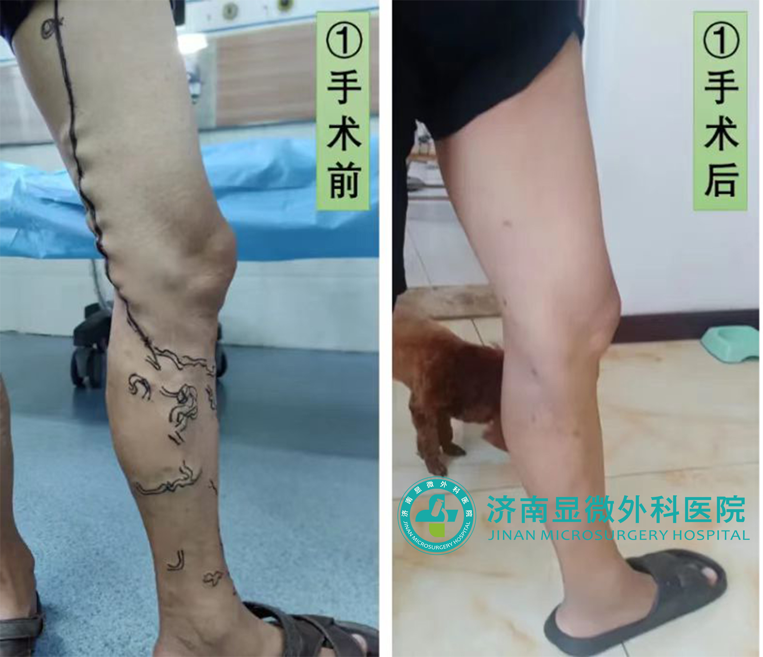 下肢静脉曲张蚯蚓腿怎么治疗,静脉曲张杨医生贵阳