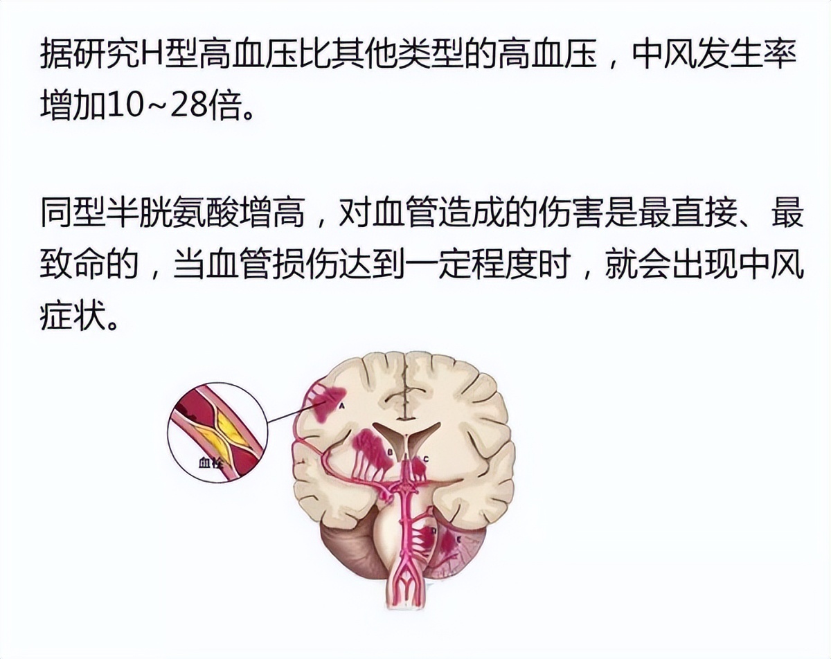 哪种叶酸片适合高血压,哪种叶酸片治高血压