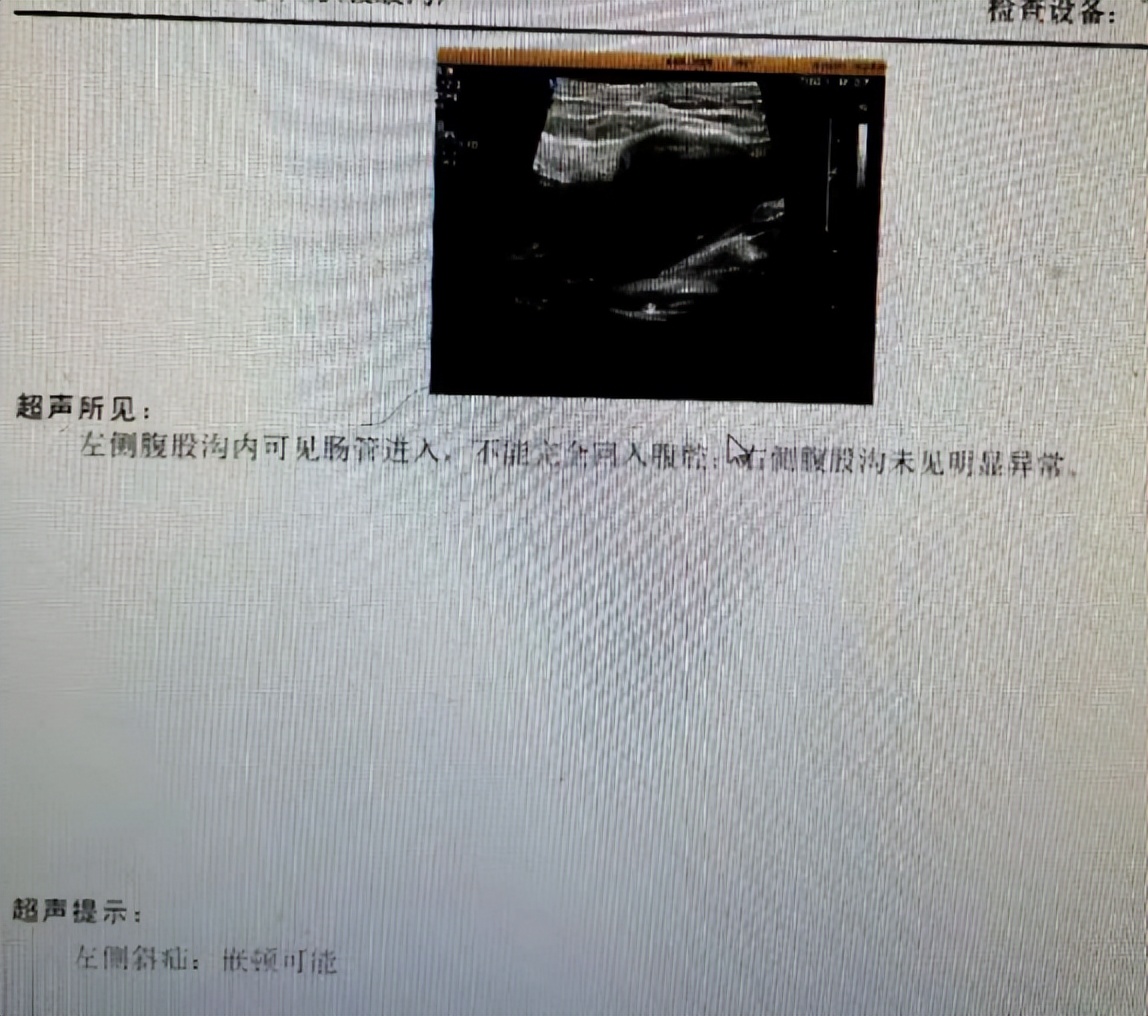 疝气做了手术感觉还鼓包什么原因,疝气不得劲怎么缓解