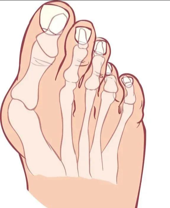 消脚垫疼痛的宝贝竟然是一种鞋垫