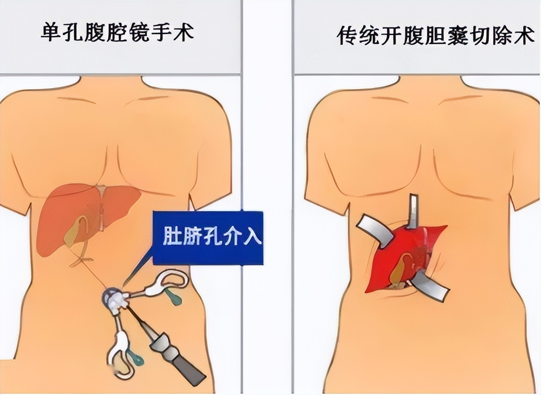 急性胆囊炎的主要治疗方法有哪些,急性胆囊炎最佳的治疗方案是什么