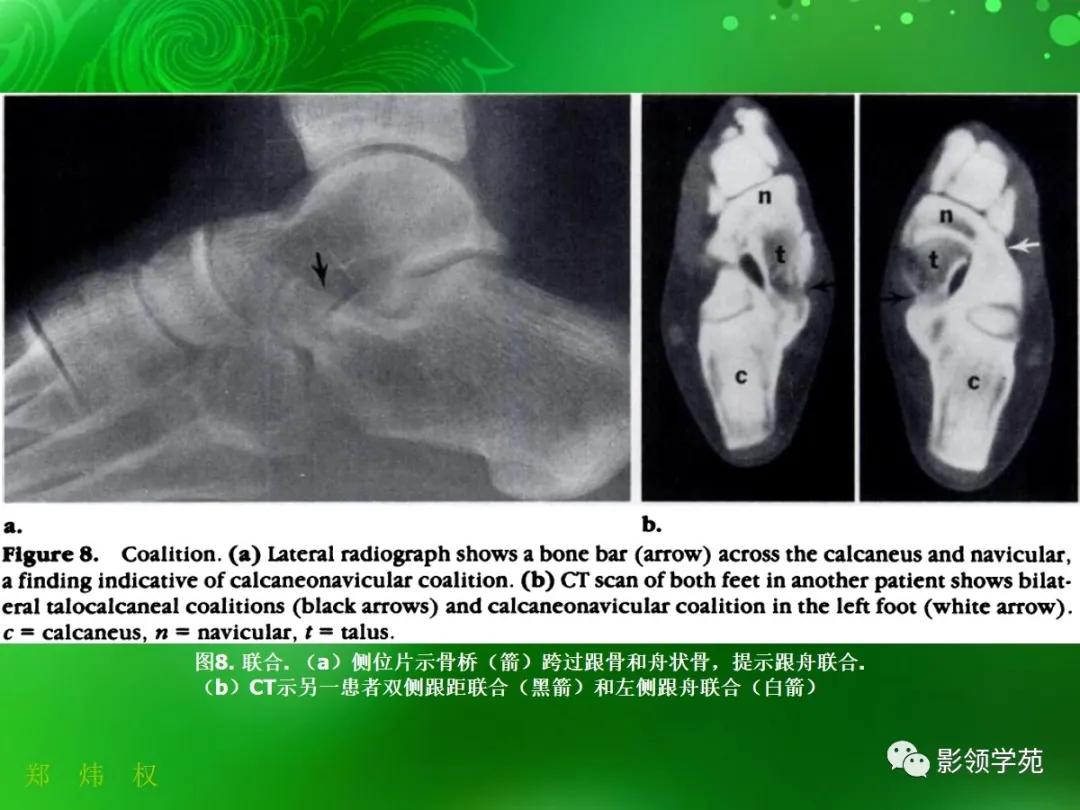 正常跟骨影像图,跟骨正常与变异影像表现图片