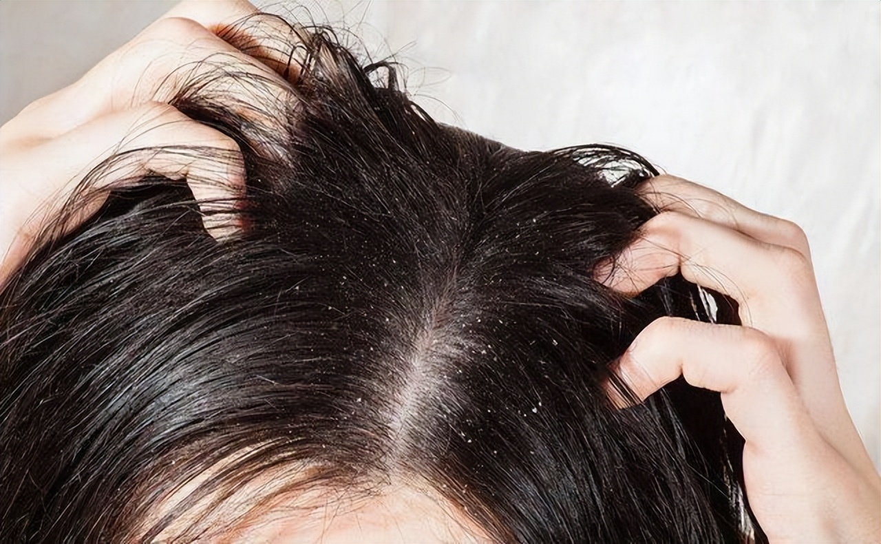 如何改善头皮长脓包和疙瘩的问题,头皮上总是长疙瘩和脓包如何根治