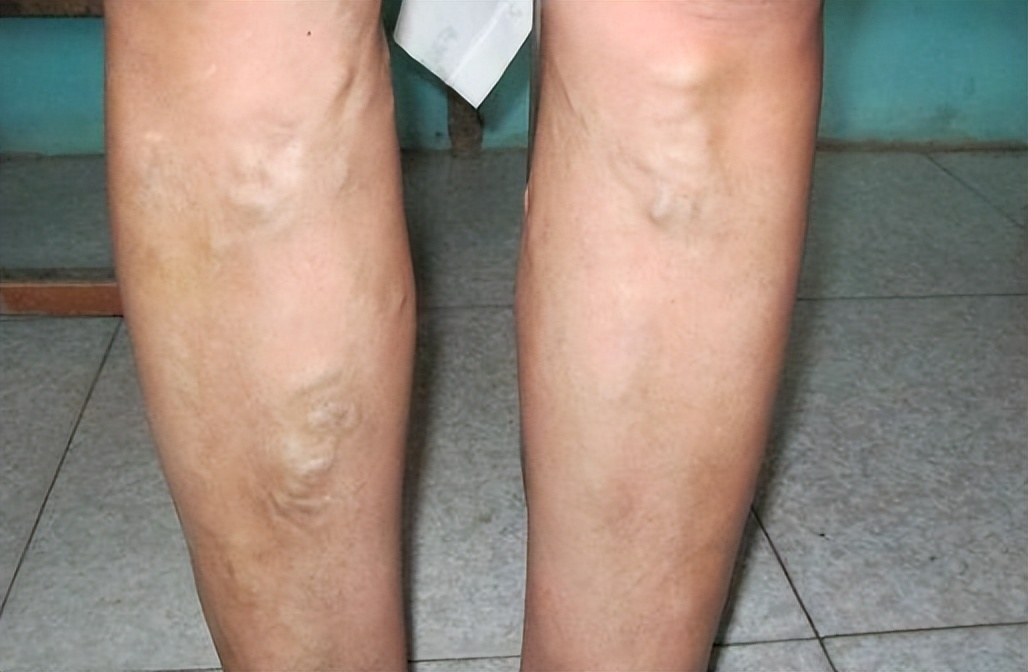 血管外科李鹏：静脉曲张2种治疗方式，预防曲张，记住这几点