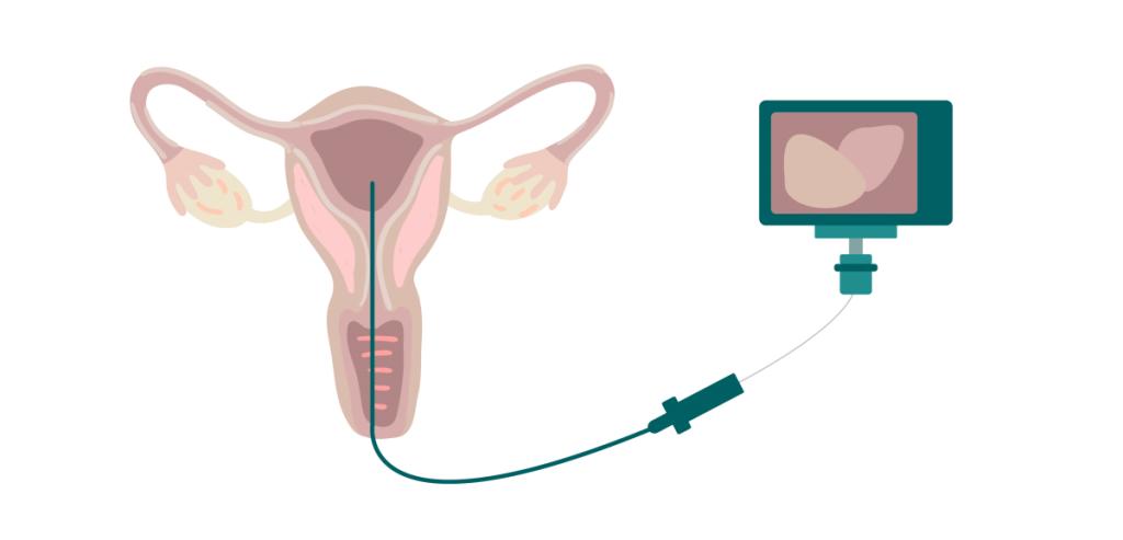 宫腔镜检查是什么意思,宫腔镜检查是什么