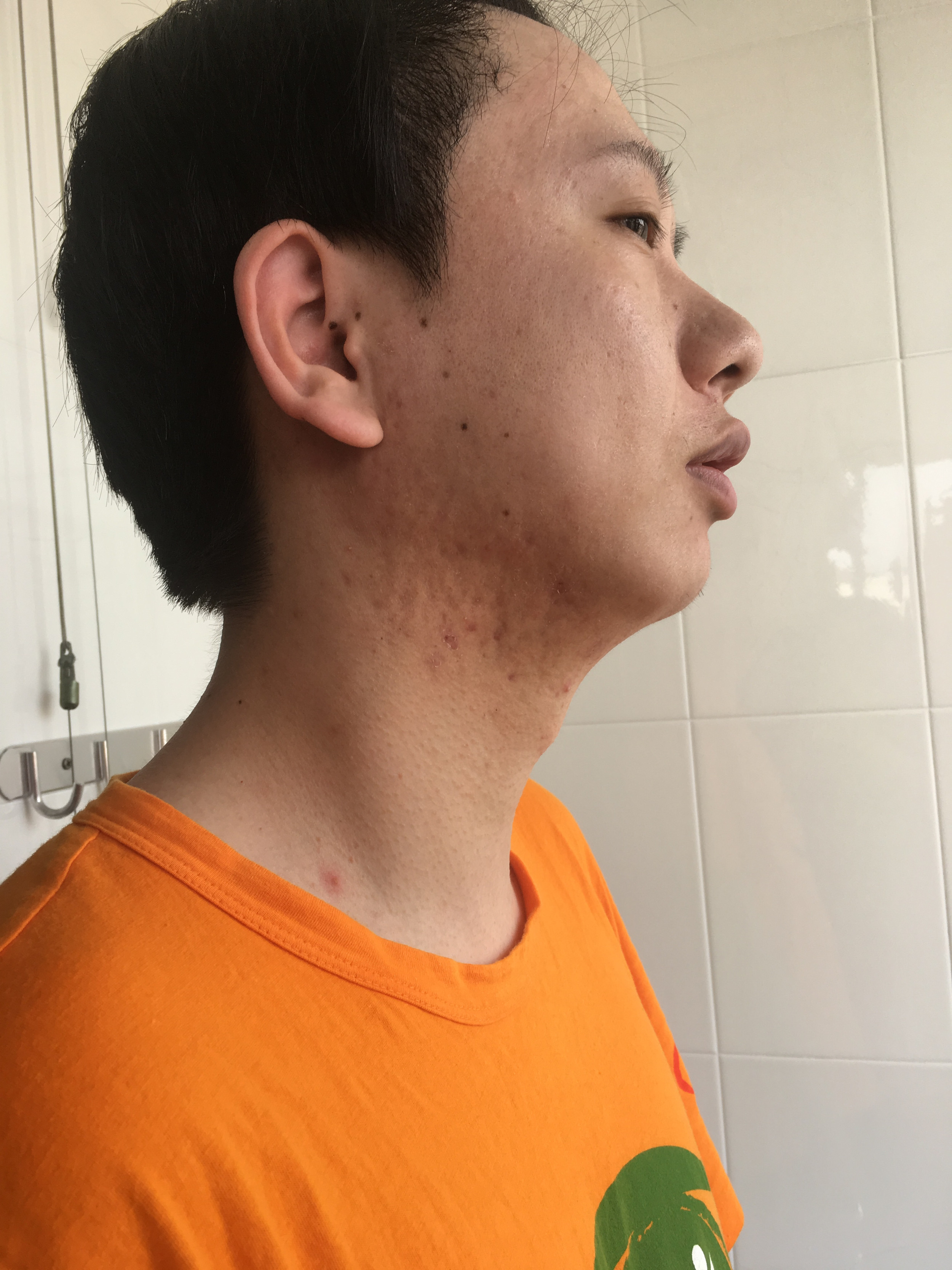 30岁男脸上痘坑可以祛除吗,小伙子痘坑修复亲身经历