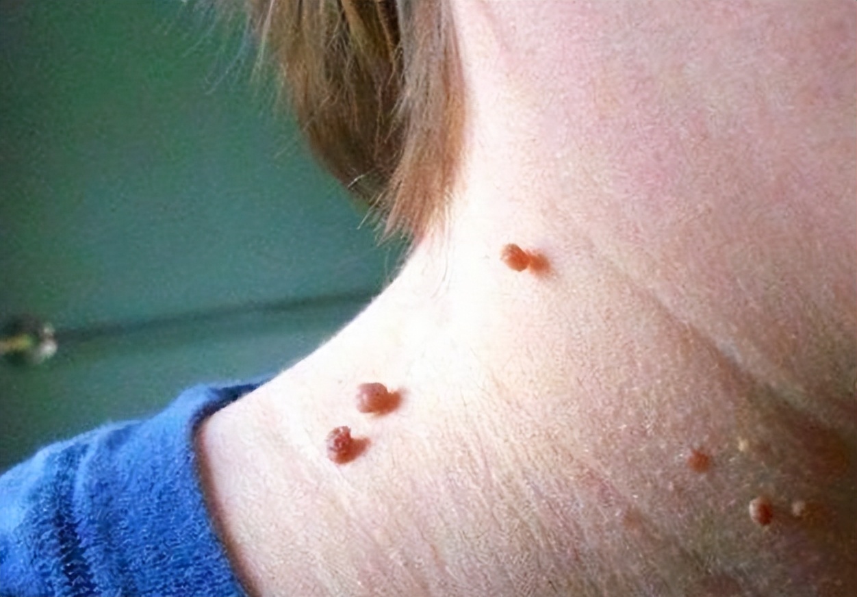 脖子上长小肉粒说明身体出了问题,脖子上的小肉粒说明身体有病