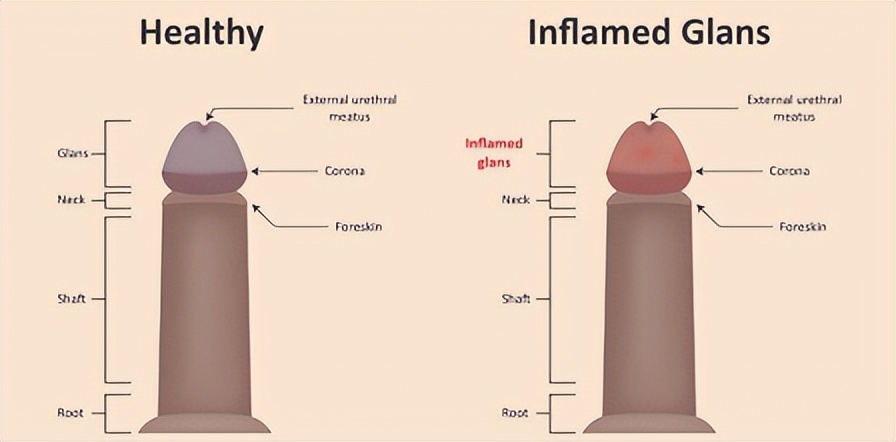 “丁头”发“炎”怎么办？—氦氖激光照射治疗为您排忧解“男”