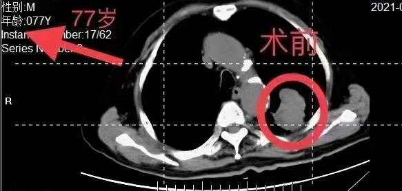 肺癌晚期放化疗和靶向药物哪个好,高龄肺癌治疗视频