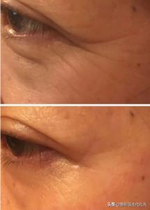 40岁以后为什么眼睛变小了,年轻人眼睛变小了怎么回事