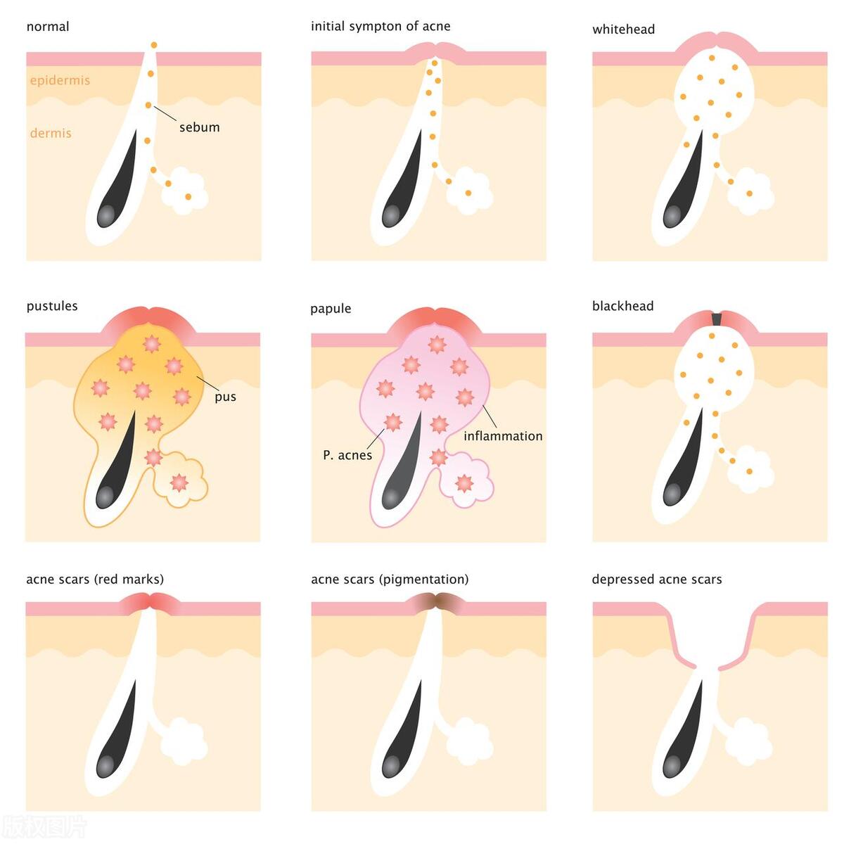 如何快速去痘疤的最好方法,祛痘疤最有效的方法学生