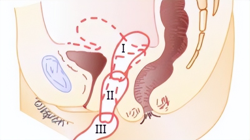 上了年龄子宫能修复吗,年纪大了子宫掉出来了