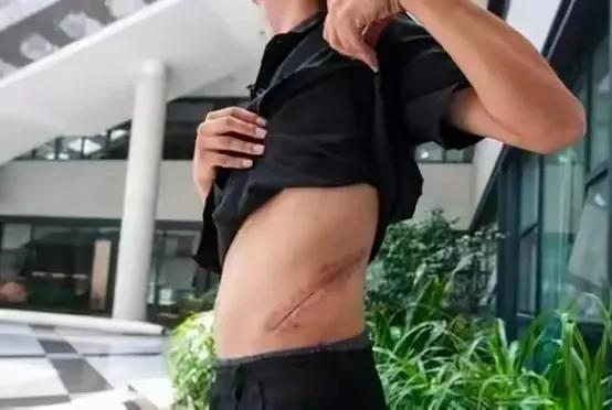 人少了一个肾，对身体危害大吗？9年前卖肾买手机的少年后悔了没