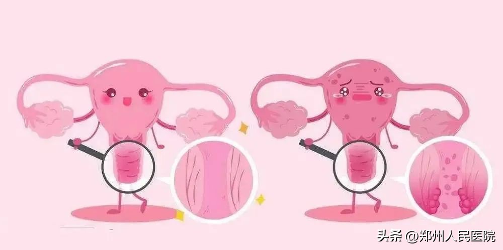 孕21周凶险性前置胎盘反复出血,凶险性前置胎盘28周早产