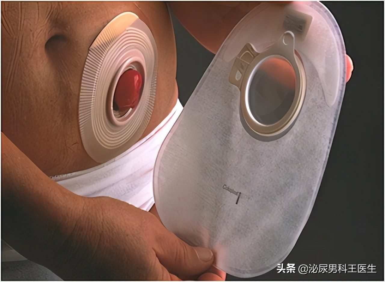 直肠癌早期身体发出3个救命信号,直肠癌症状是先下坠还是便血