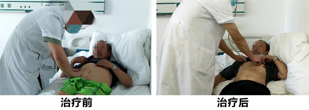 酒精肝发展至肝硬化腹水，源头治肝效果奇佳！