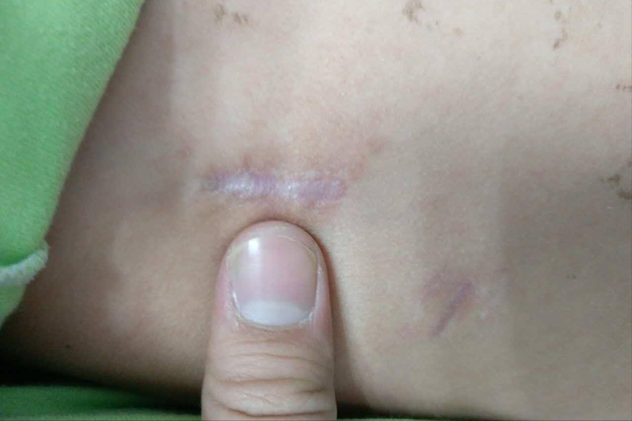 全胸腔镜下，与右侧开胸小切口房间隔缺损修补术的临床结果分析