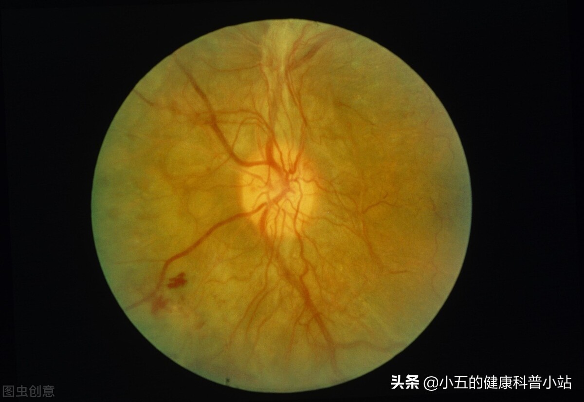 糖尿病长期吃药肾受损怎么办,糖尿病如何损伤血管的
