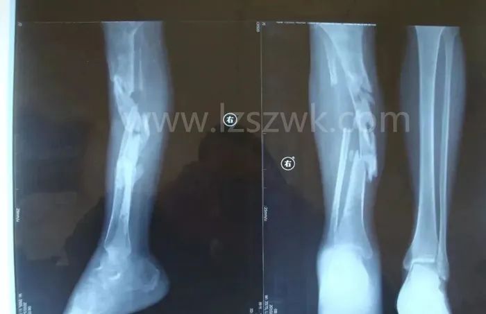 如果有一段骨头缺损，该怎样治疗？