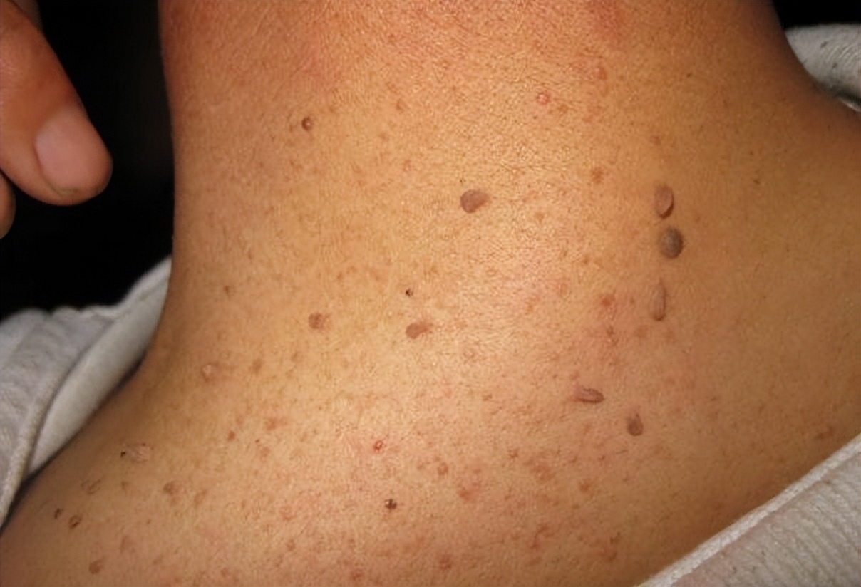 脖子和腋下的小肉粒可以揪了吗,脖子上的小肉粒揪掉后会怎样