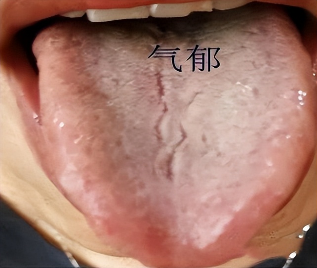 舌根部有裂纹是什么舌象,舌有裂纹7种原因通过舌象来调理