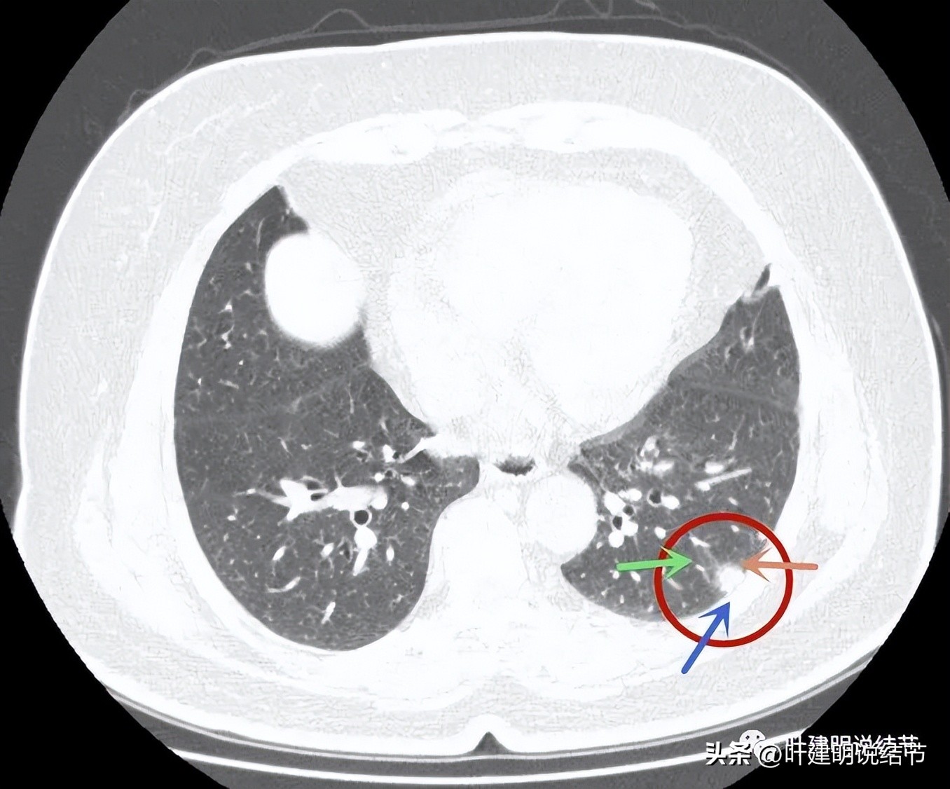 肺结节实性为什么建议抗炎治疗,肺上实性结节抗炎后变成空洞