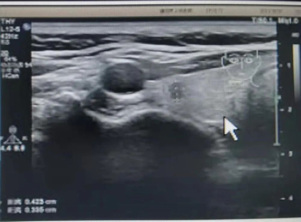 案例分享：3分钟“治愈”甲状腺乳头状癌