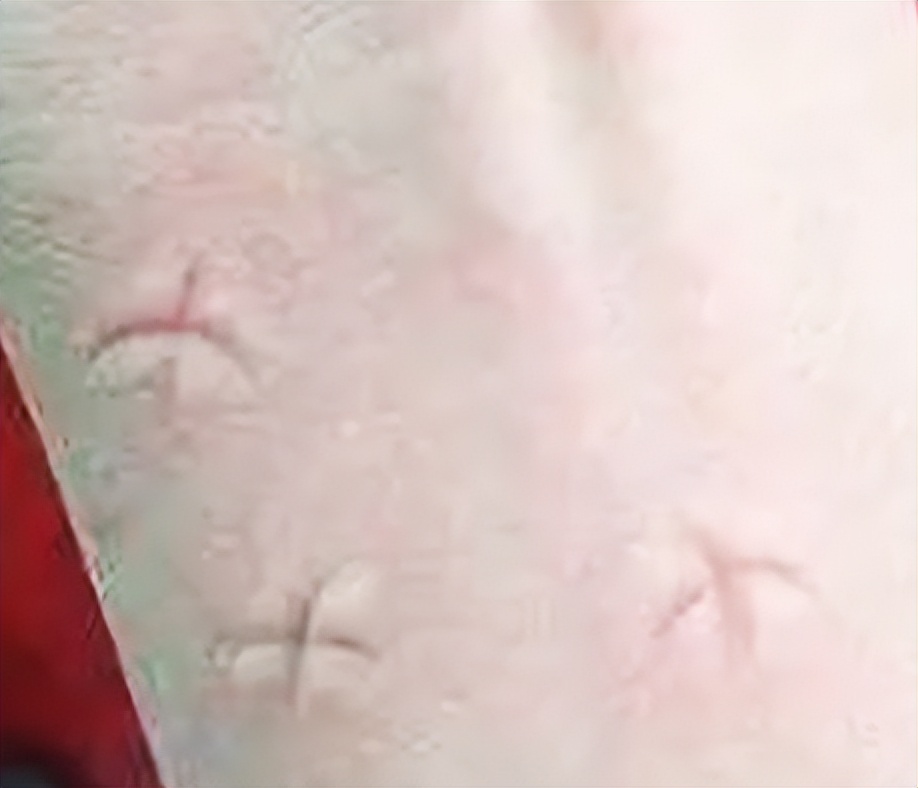 为什么有些人更容易被蚊子叮,为什么有人更容易被蚊子叮